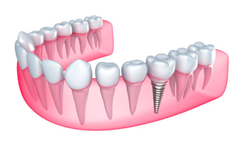 Implant surgery